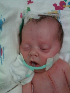 Julie after 2nd surgery. Notice the breathing & feeding tubes