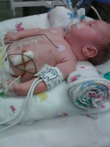 Julie after 4th surgery