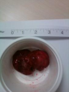 Mass removed from Julie's chest